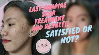 LAST SESSION VAMPIRE FACIAL SCAR TREATMENT |SATISFIED OR NOT? | PRETTYDOSE