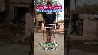 Bone Cancer #osteosarcoma proximal tibia patient on path to recovery- Dr Rajat Gupta