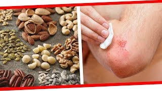 6 High Protein Foods Best for Wound Healing