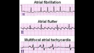 PASIEN SHOCK dengan A. Flutter, MAT dan Atrial Fibrillasi. Mana yang harus diKARDIOVERSI?