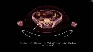 Alveolar Rhabdomyosarcoma.mp4