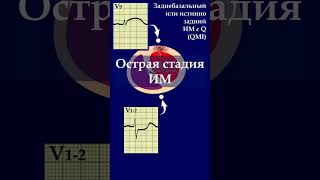 ЭКГ. Заднебазальная локализация инфаркта миокарда (QMI) #shorts