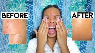 GET RID OF PIMPLES FAST | skincare routine for active breakouts