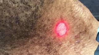 Laser hair removal for razor bumps on a black man’s neck