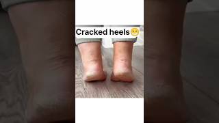 Home remedies for cracked heels#shorts#youtube