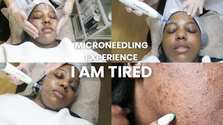 Microneedling GONE WRONG (acne, hyperpigmentation, pimple popping)