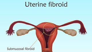 uterine fibroids #uterus #uterinefibroid #uterinehealth #uterine #fibroid #fibroidsymptoms