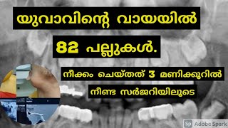 യുവാവിന്റെ വായിൽ നിന്ന് നീക്കം ചെയ്തത് 82 പല്ലുകൾ |Dr.Anagha Cheleri