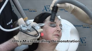 Ultra Microneedling Demonstration 17 - A E Skin - Encino, CA - 818-835-1833