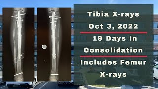 Height Journey - Tibia X-rays 19 Days In Consolidation