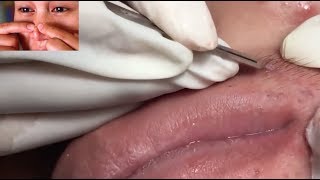 TONS of Blackhead & Whitehead Extractions on Mouth, Lips & Chin!