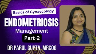 Endometriosis Part : 2 | Management