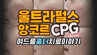 레이저박피. 울트라펄스앙코르 CPG 경과