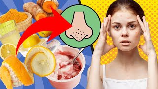 Blackheads - 11 Amazing Natural Cures for Blackheads