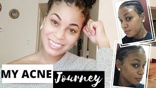 My Acne Journey l How I Was Able To Get Rid Of Acne, Hyperpigmentation, Blackheads and Dark Marks