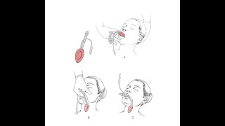 How to Insert a Laryngeal Mask Airway | Merck Manual Professional Version