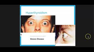 Thyroid Disorders