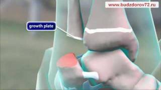 Medical Animation. Fracture of the ankle in children