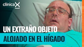 Un dolor abdominal que esconde un absceso en el hígado | Clínica X