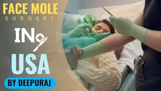 Mole surgery in USA