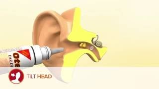 How to use Otex Ear Drops