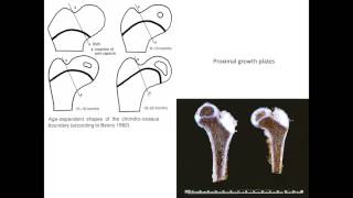 Development of Hip - J Fernandes, UK