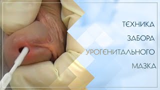 Техника забора урогенитального мазка. Клинический случай №16