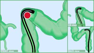 SIGMOID INTUBATION - Push Tecnique: Standard Colonscope