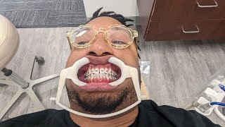 Getting My Braces!