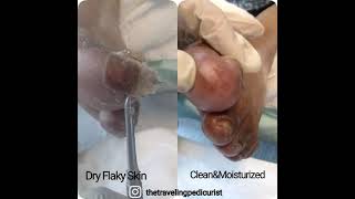 Flaky Dry Skin👣    APPOINTMENTS Call:               (919) 621-7027