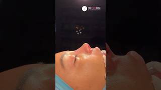 Direct result after Closed Scarless Rhinoplasty | Dr. med. Simon Zimmermann