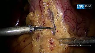 Weight loss surgery: Laparoscopic Sleeve Gastrectomy with Omentopexy demonstration.