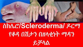 ስክሌሮ ዶርማ /Scleroderma/የቆዳ በሽታን በዘላቂነት ማዳን ይቻላል