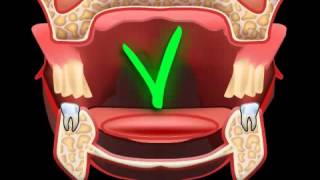 How to avoid pressure points of dentures