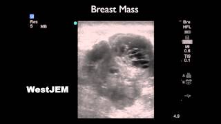 Evaluation of Breast Disorders with Ultrasound