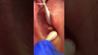 Ear blackheads in this week