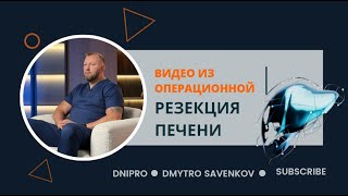 Резекция печени I Онкохирург  I Савенков Дмитрий  I Днепр