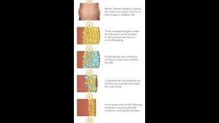 Coolsculpting vs. Liposuction