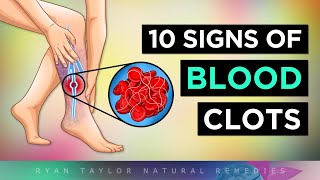 Top 10 Warning Signs of BLOOD CLOTS