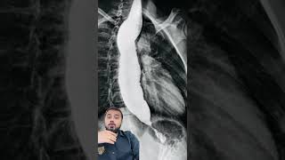 Achalasia cardia #drkrishna #neet #mbbskyrgyzstan #ihsm #biology #fmgs #science #doctor