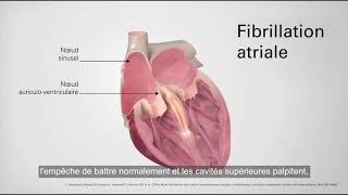 Qu est ce que la Fibrillation Atriale?