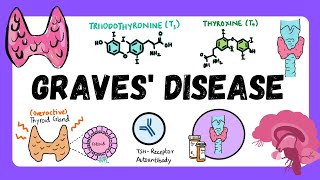 Graves Disease | Physiology | Pathophysiology, Diagnosis, Treatment | Endocrinology