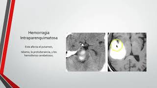 Neuroradiología 2