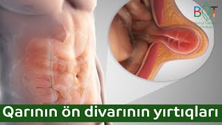 Qarının ön divarının yırtıqları və bu yırtıqların cərrahi müalicəsi