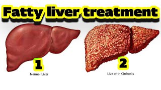 Treatment of fatty liver and its symptoms in the human body.؟#fatty_liver #treatment #کبدچرب #کبد