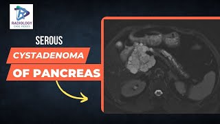 Serous Cystadenoma of Pancreas