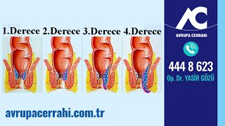 Hemoroid (Basur) Evreleri Nelerdir