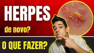 O que fazer para curar e evitar a Herpes?