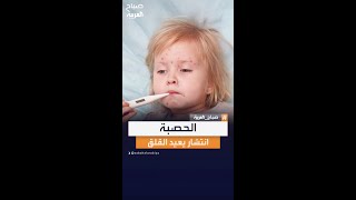 احذر.. الحصبة تعود مجددا حول العالم