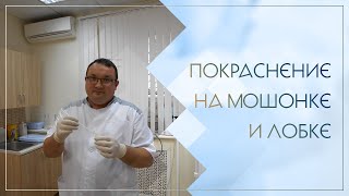 🙁 Покраснение на мошонке и лобке. Клинический случай №94